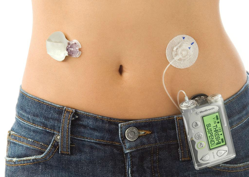 A step toward an artificial pancreas, Medtronic insulin pump passes key ...